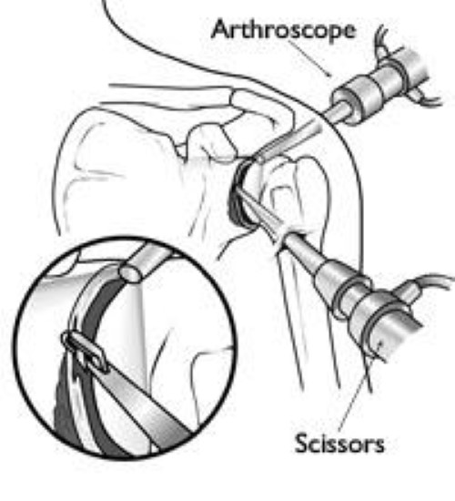 artroscopia de hombro