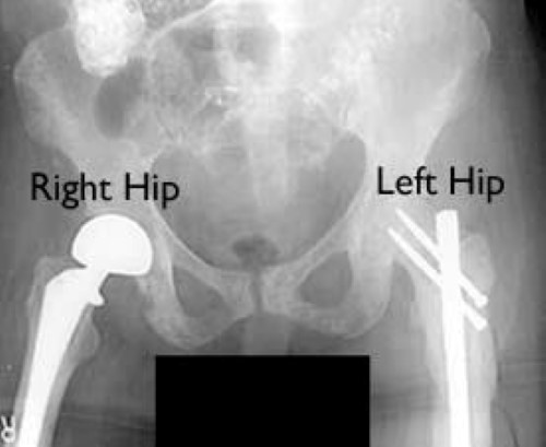 Bone cancer in the hip: Types, symptoms, and treatment