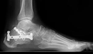 Internal fixation of calcaneus (heel bone) fracture