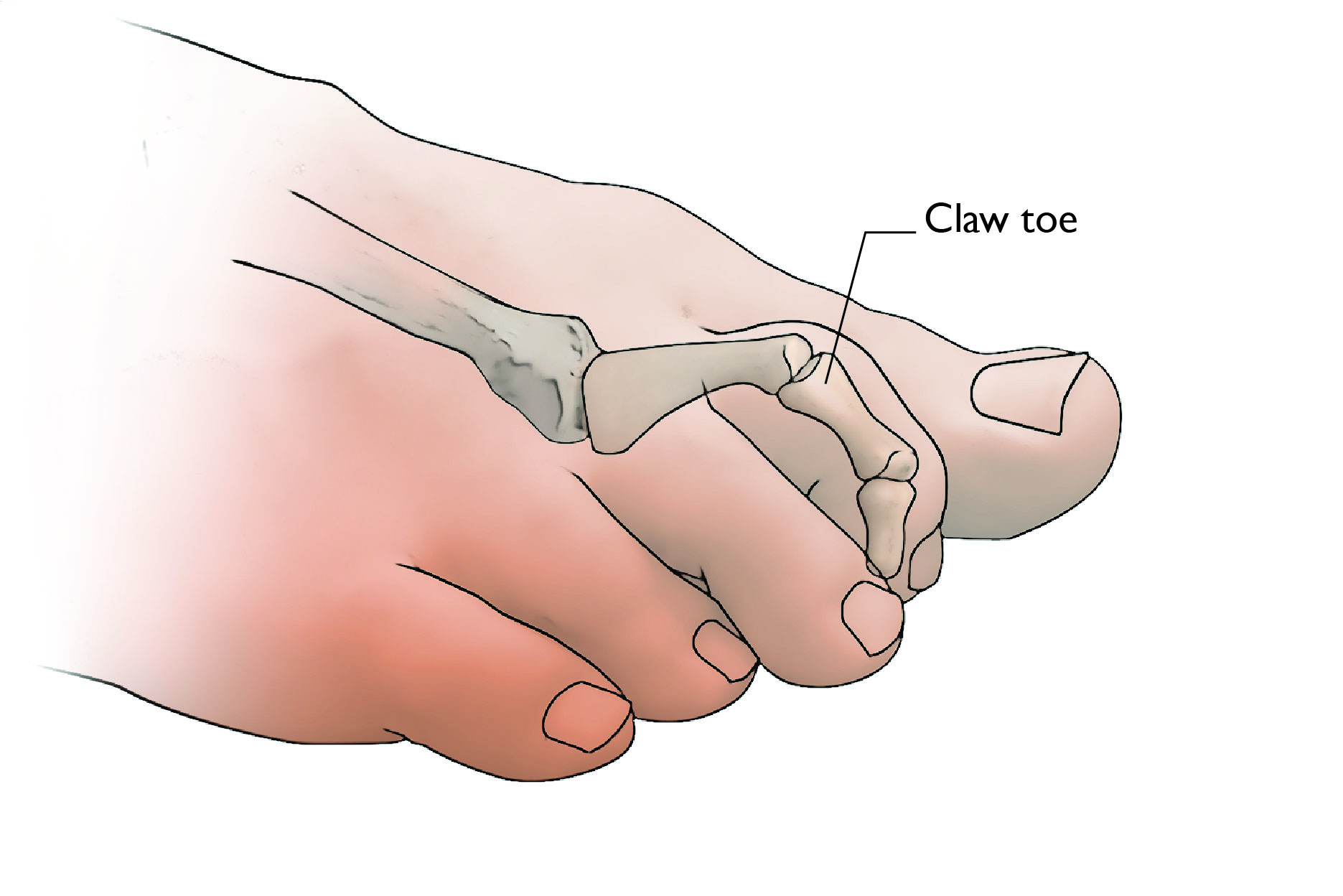 Claw toe