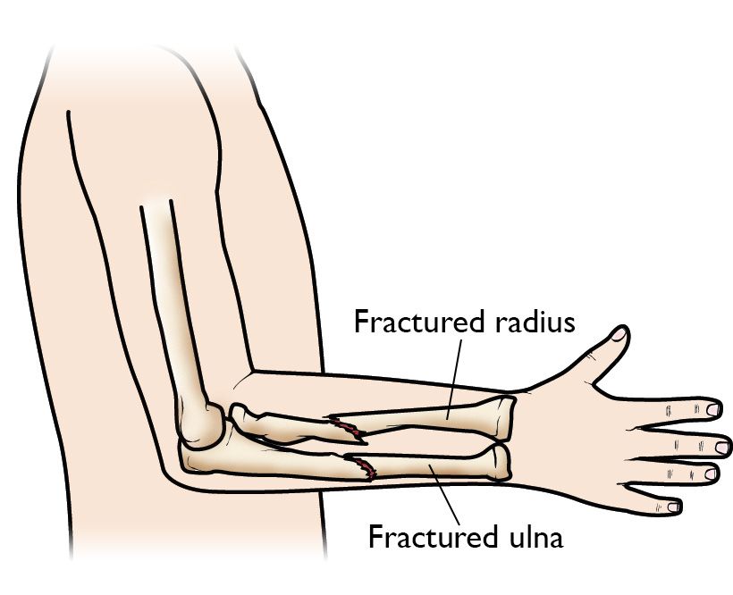 compression fracture arm