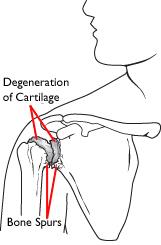 Osteoarthritis of the shoulder