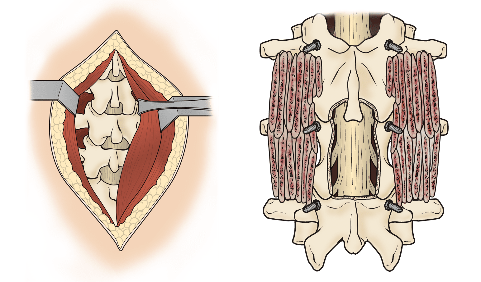 Spinal stenosis Information