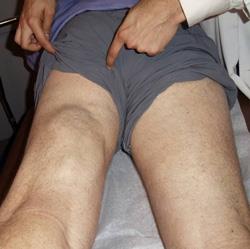 Hamstring Surgery