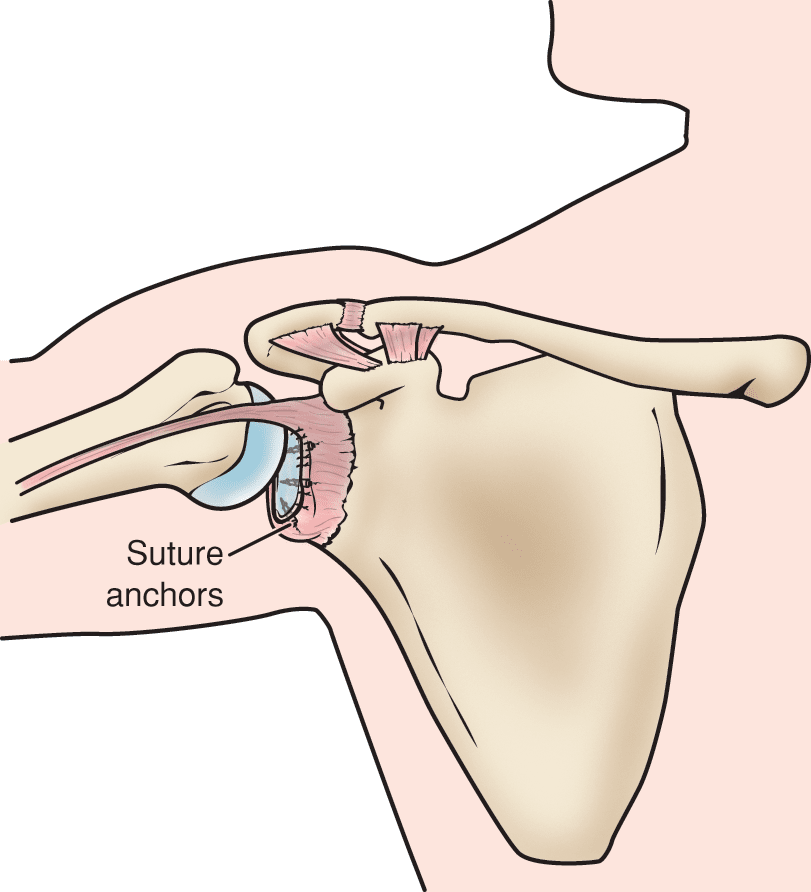 Surgical repair of a Bankart lesion