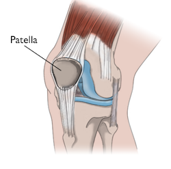 Patellar Dislocation: What Is It, Causes, Diagnosis, Treatment