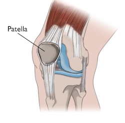 Patella out of clearance place