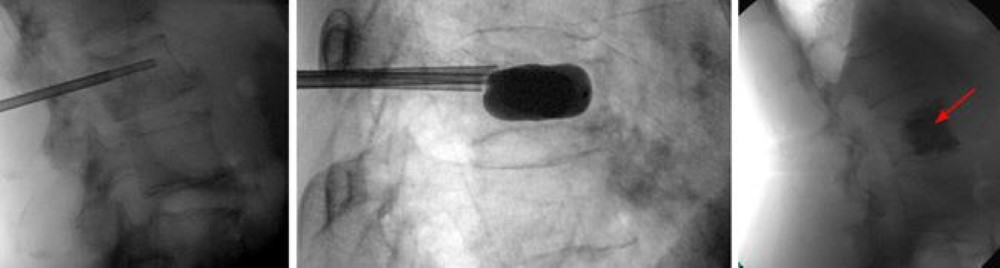 Osteoporosis and Spinal Fractures - OrthoInfo - AAOS