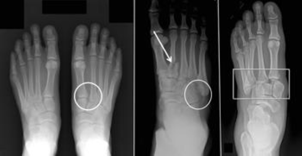 ͬ͵Lisfranc