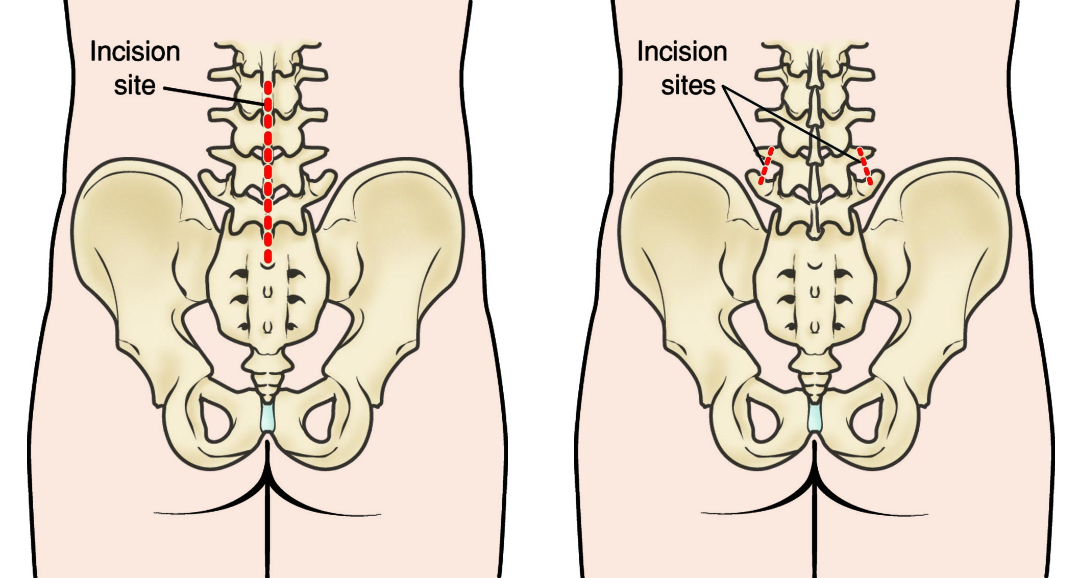 Minimally Invasive Spine Surgery Orthoinfo Aaos - 