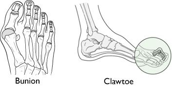 Rheumatoid Arthritis of the Foot and Ankle - OrthoInfo - AAOS