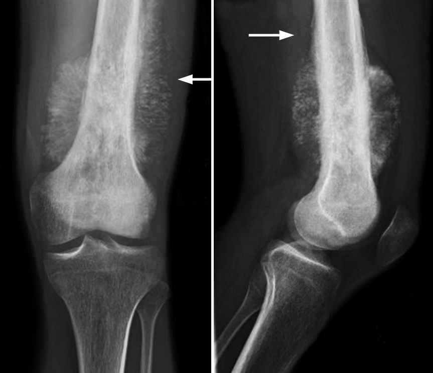 Radiografía de osteosarcoma en fémur