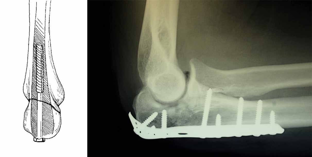 Internal fixation of olecranon fractures