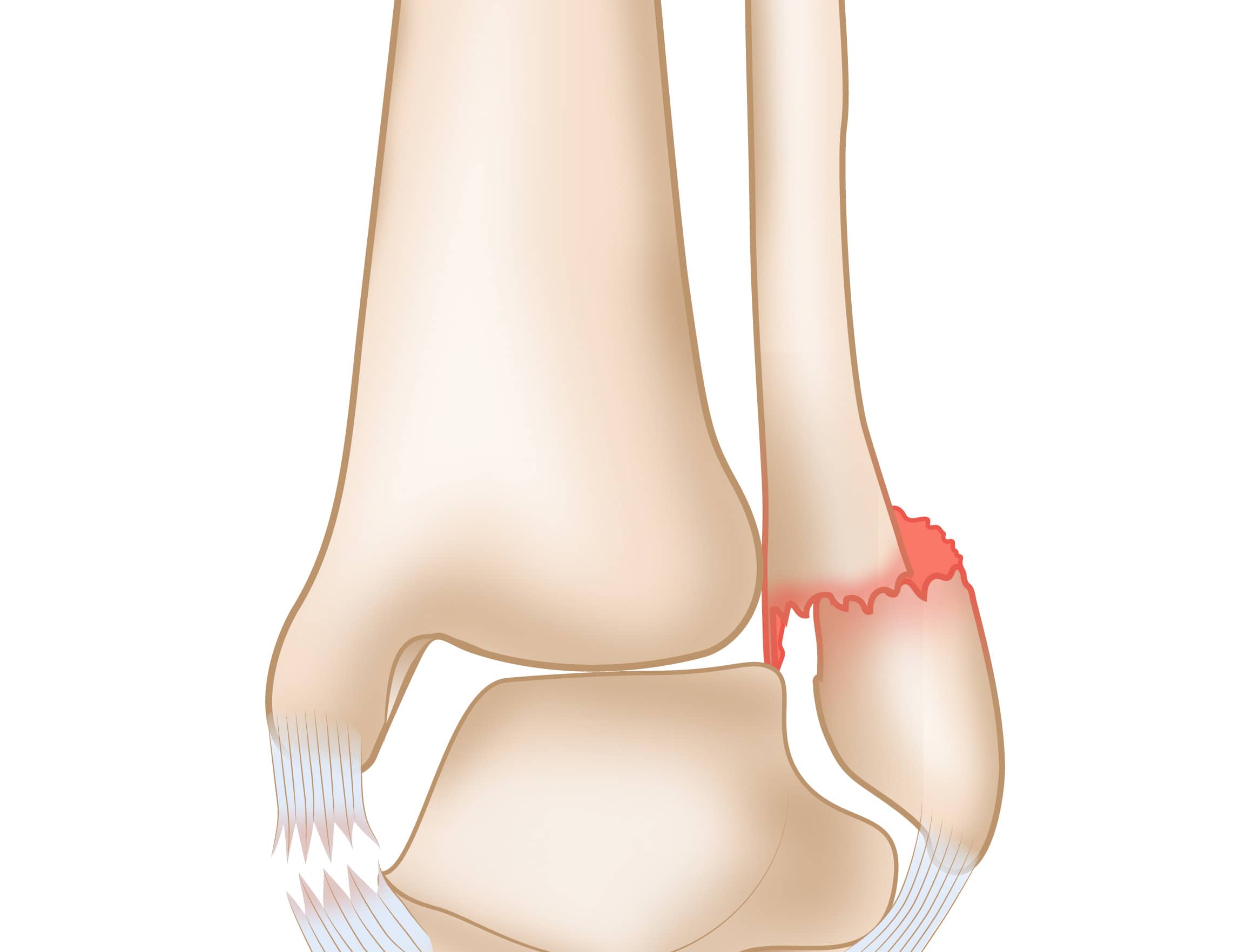 Broken Ankle Surgery  Symptoms, treatment & surgery options %