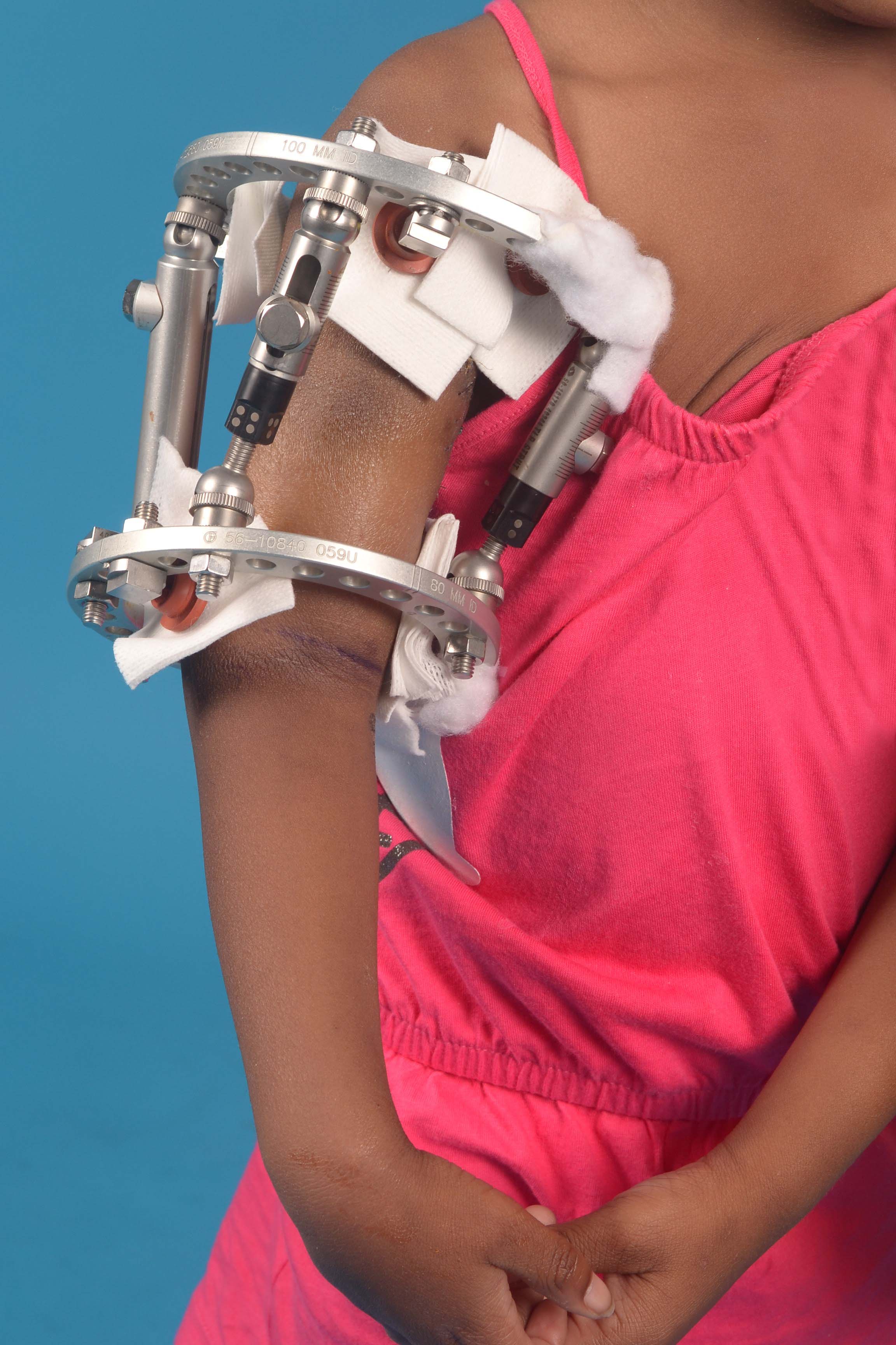 Upper Extremity Limb Length Discrepancy OrthoInfo AAOS