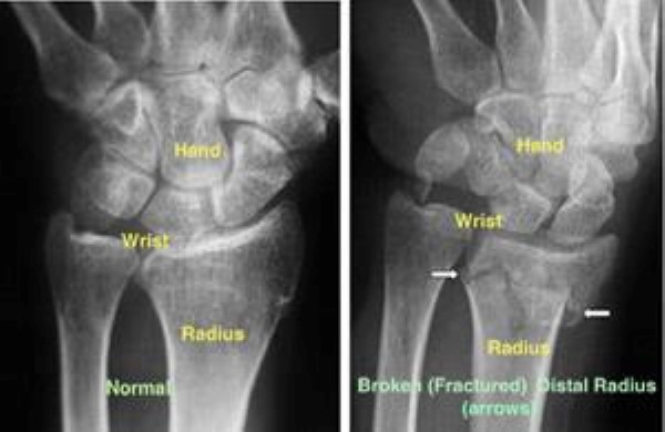 radius fracture