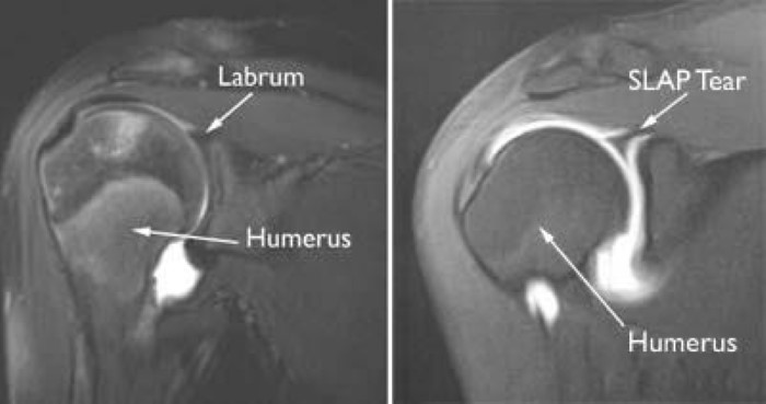 Posterior Labral Tears And Slap Tears Adam Watson Orthopaedic Surgeon