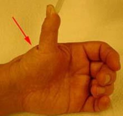 Thumb extension deformity due to arthritis