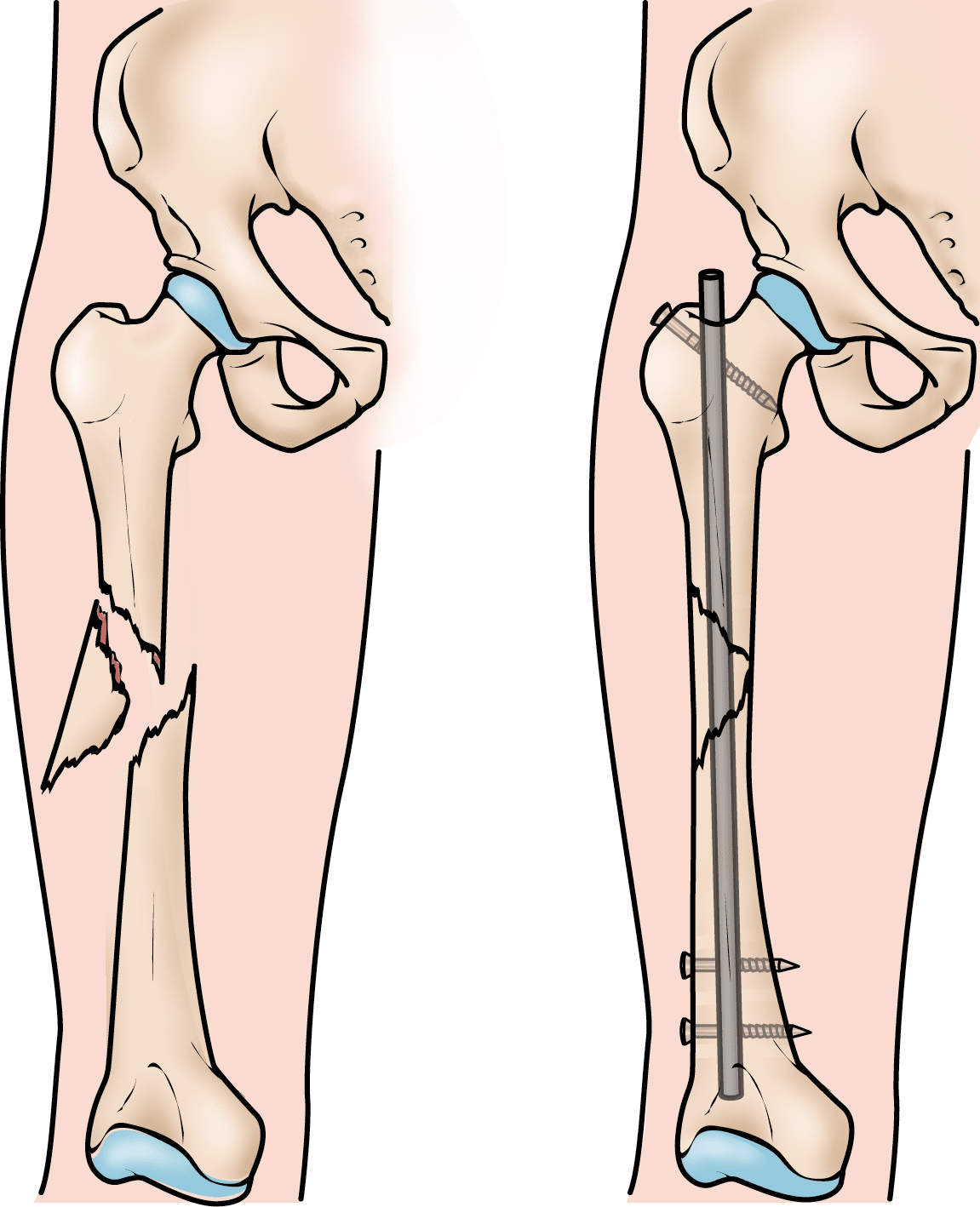 Femur (thighbone) fracture treated with intramedullary nail