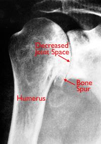 glenohumeral joint degeneration