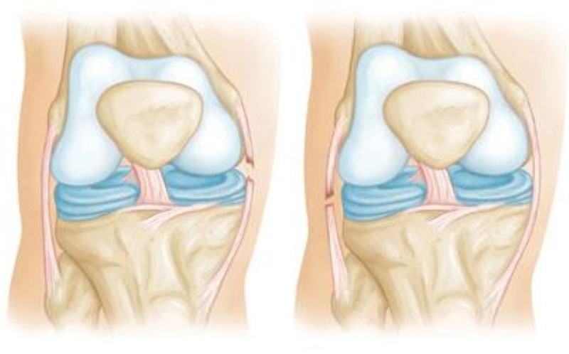 fibular collateral ligament tear