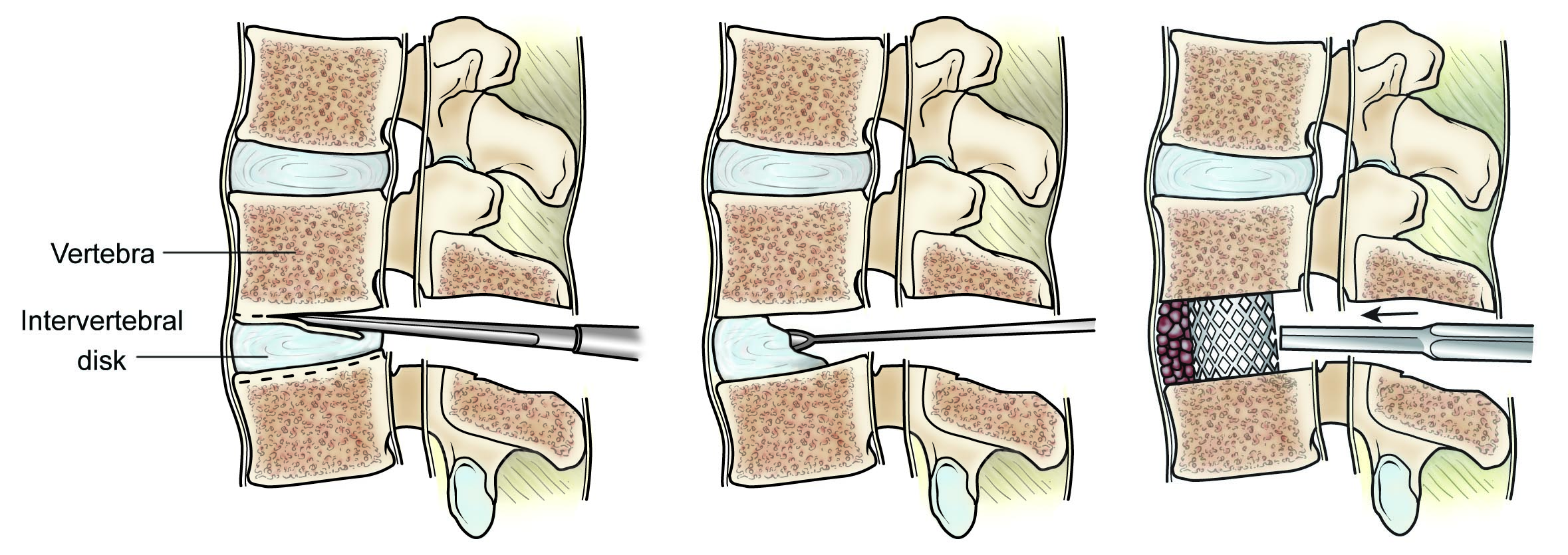 intervertebral disk removed and replaced with a cage