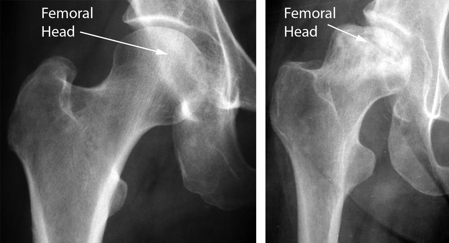 Normal hip and hip with osteonecrosis