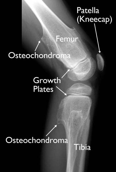 chondroma in knee x ray