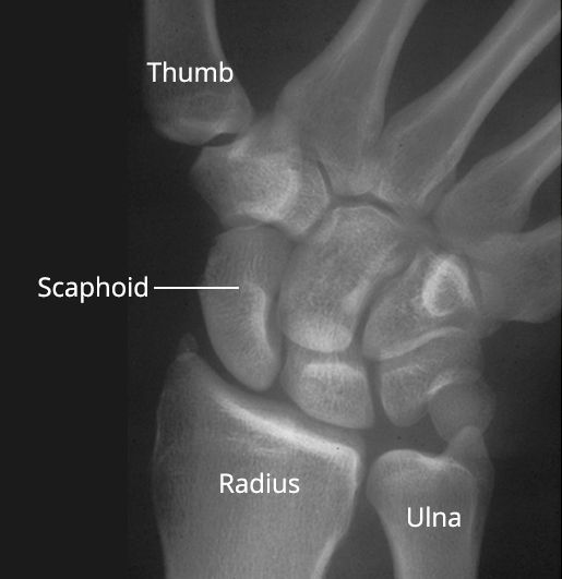 Wrist Sprains - OrthoInfo - AAOS