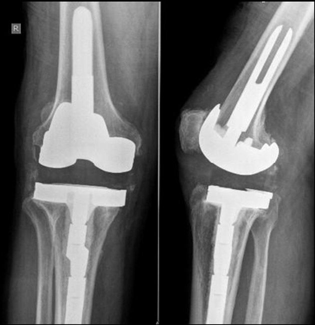 Knee components used in a revision surgery