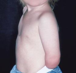 below-elbow transverse deficiency