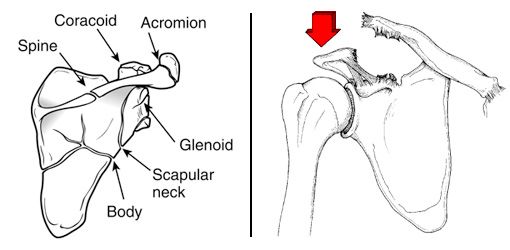 Ilustraciones de patrones de fractura en la escápula y dislocación de la articulación acromioclavicular