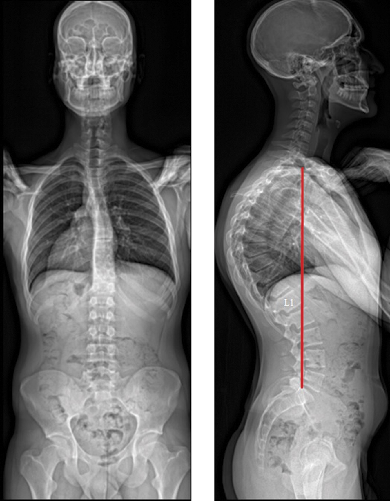 X-ray showing thoracic kyphosis measuring 82 degrees