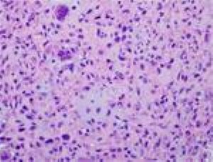 chondromyxoid fibroma pathology slide 