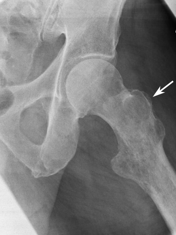 X-ray of tumor 