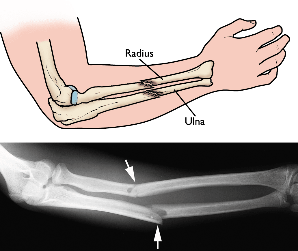 Fractures of both the radius and ulna. 