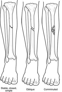 Fractures Broken Bones Orthoinfo os