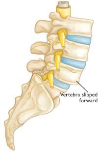 Degenerative spondylolisthesis