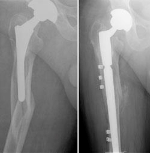 x-rays of loose implant and joint revision