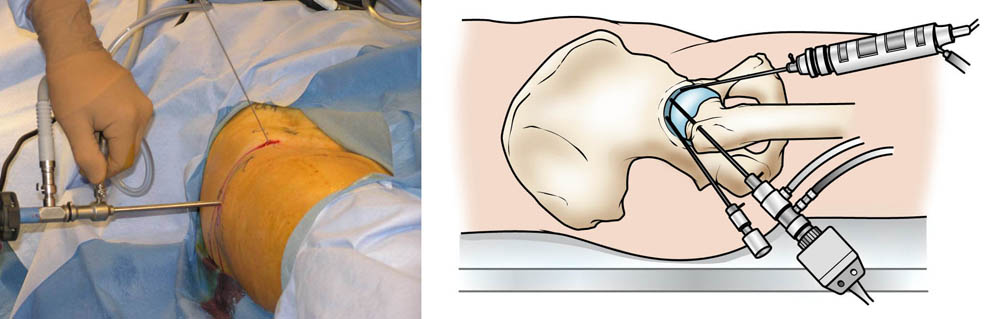 Hip microinstability in cam-type FAIS