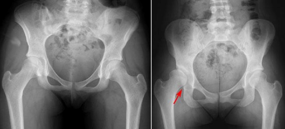 Hip dysplasia hotsell