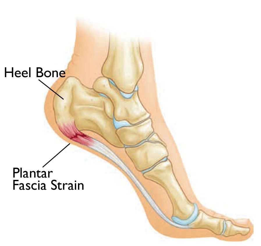 heel pad injury