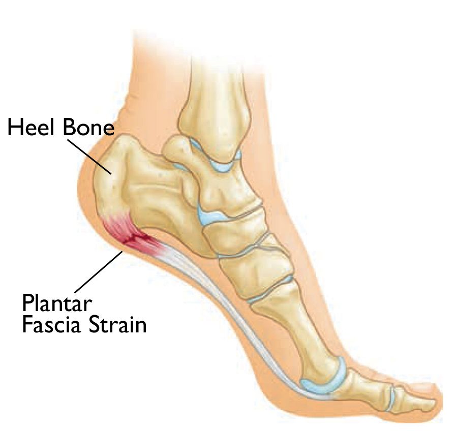 Causes Of Heel Pain On Bottom Of Foot Deals Emergencydentistry