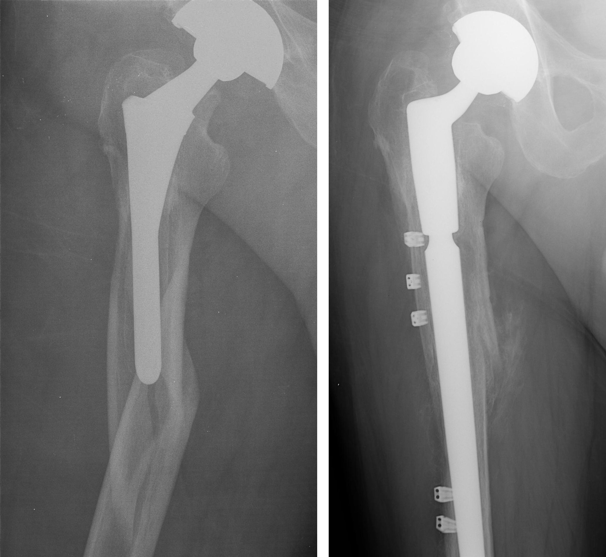 Periprosthetic Fracture After Total Hip Replacement Dr Mukhis Raj