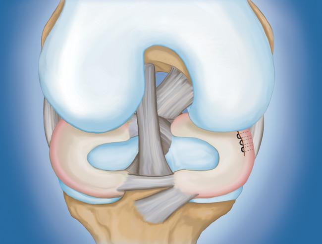 Un menisco roto reparado con suturas