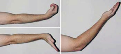 Ulnar nerve entrapment at the elbow (Cubital Tunnel Syndrome