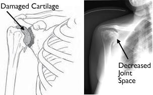 Illustration and x-ray showing osteoarthritis of the shoulder