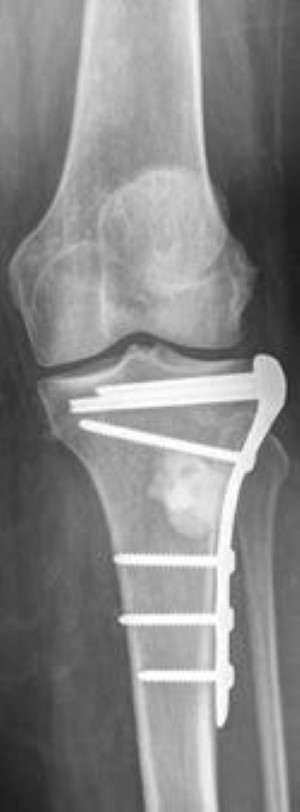 tibia stabilization in MBD