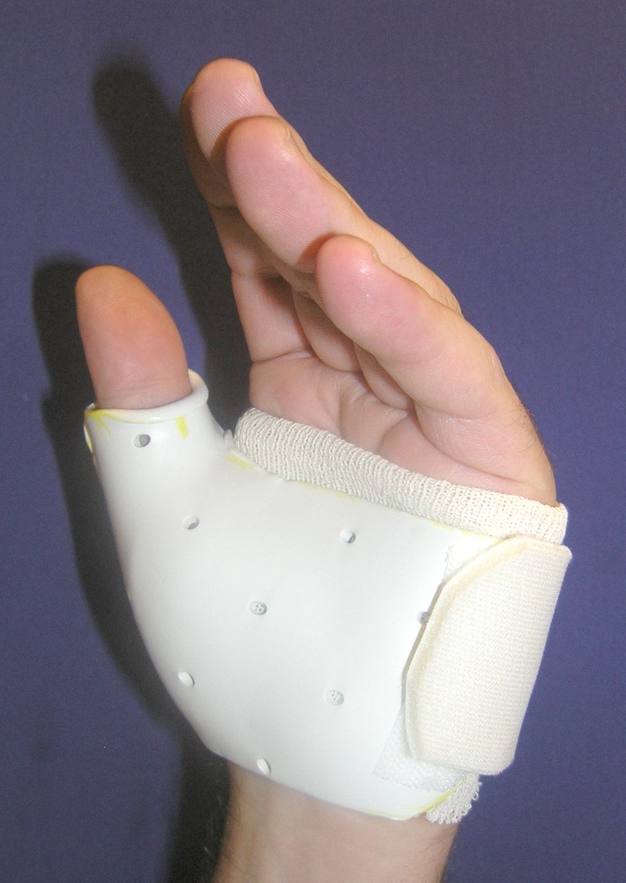 Thumb Spica Splint, Skier & Game Keeper's Thumb