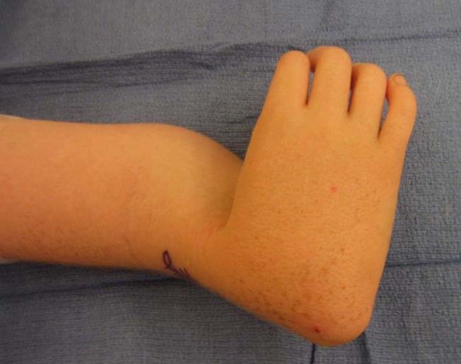 Upper Extremity Limb Length Discrepancy OrthoInfo AAOS